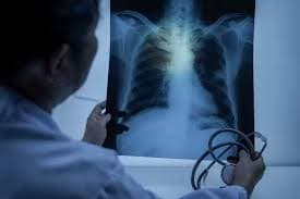 Study identifies immune cells that can attack deadliest lung cancer