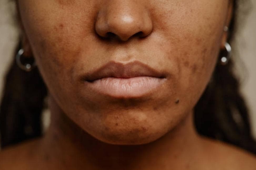 Skin problems on the rise in Kenya — Is our environment making it worse?