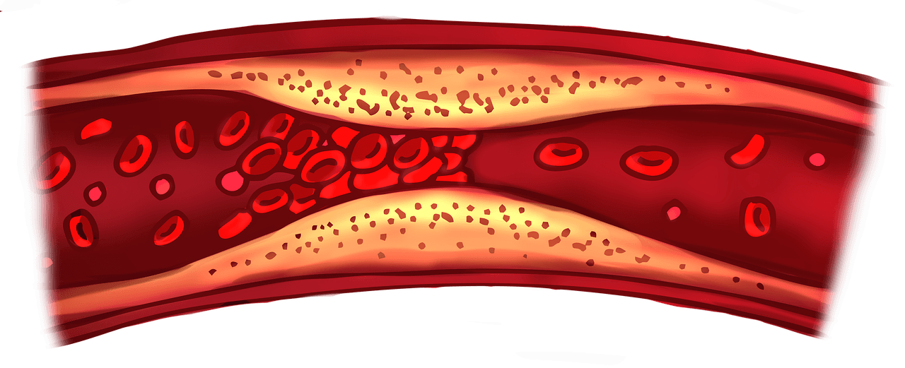 Having an operation done? Know your risk of clotting