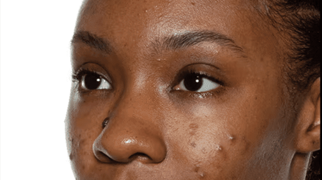 Skincare: 6 Mistakes To Avoid When Treating Acne