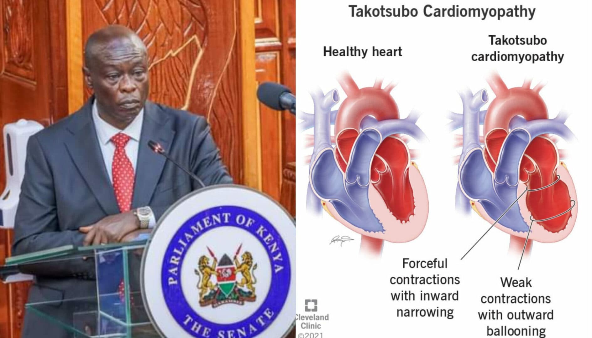 Details of Gachagua’s ‘broken heart’ condition, symptoms, treatment