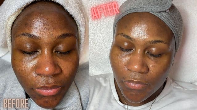 What Microdermabrasion Can Do For Your Skin