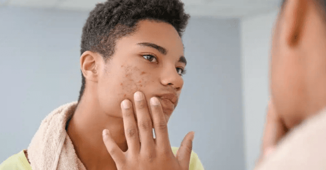 5 Skincare Products That Are Essential For Teenagers