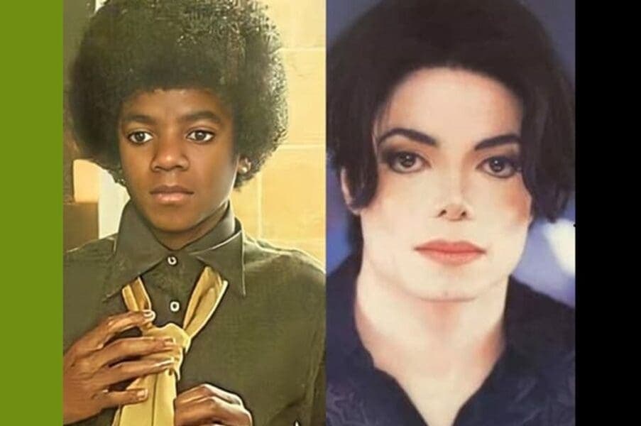 Michael Jackson Did Not Bleach His Skin to Appear White – Vitiligo