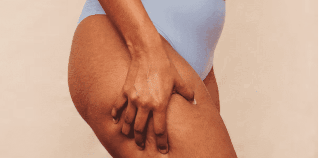Here Are Some Exercises And Skincare Products For Cellulite Reduction