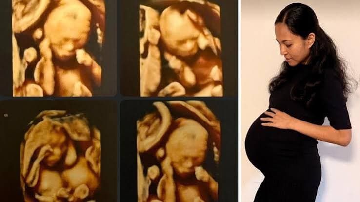 Rare identical quadruplets born in Australia