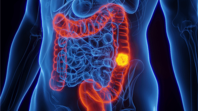 Why Colorectal (Colon) Cancer Is Increasing Among Young People