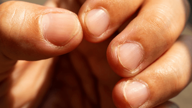 Five Hacks To Stop Nail-Biting