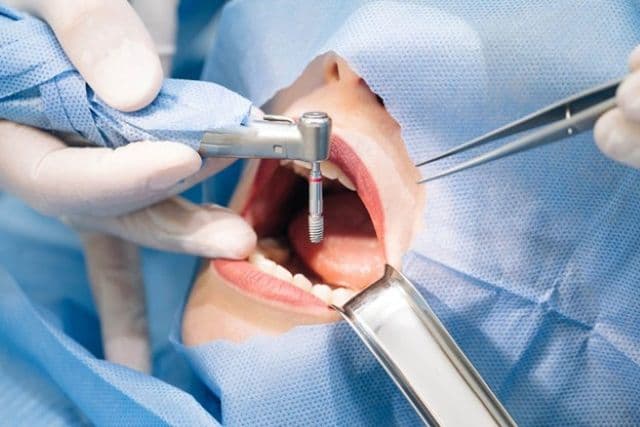 Signs You Might Need Oral Surgery And How To Prepare