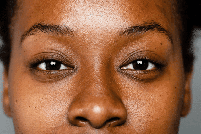 5 Home Remedies For Skin Pigmentation