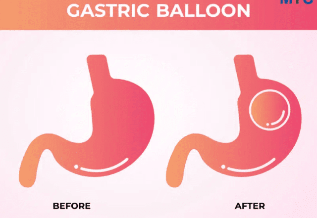 Gastric Balloon Surgery: A Non-Invasive Surgical Approach To Weight Loss