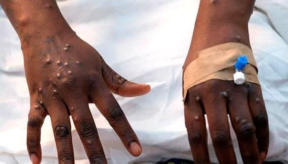 Embu County confirms first case of mpox disease