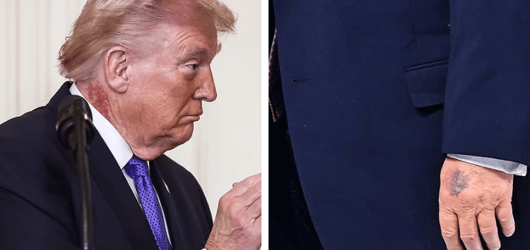 Trump Heads Back to Hospital as Bruises, Swollen Ankles Fuel New Concerns