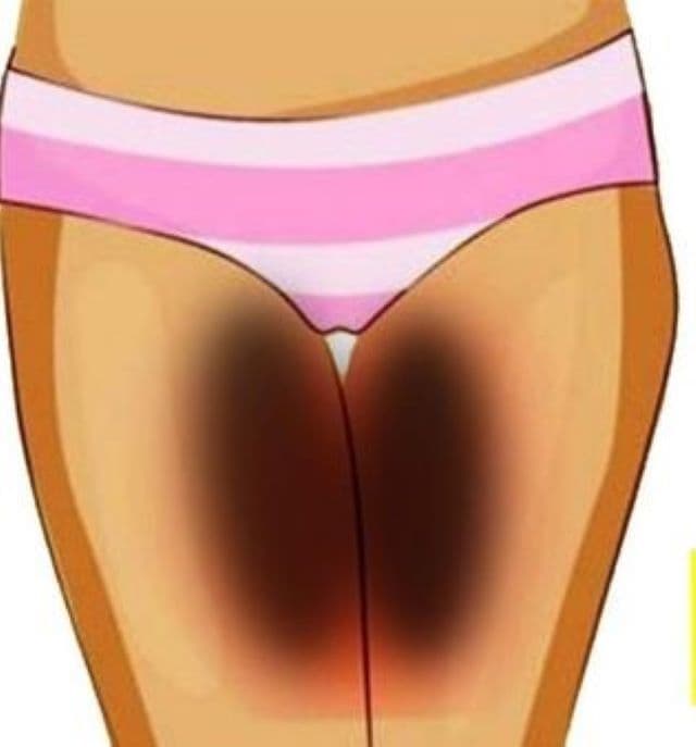 Home Remedies For Dark Inner Thighs