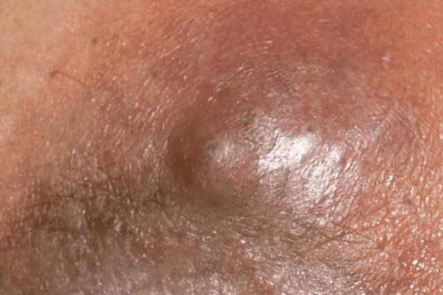 Health: Home Remedies For Boils