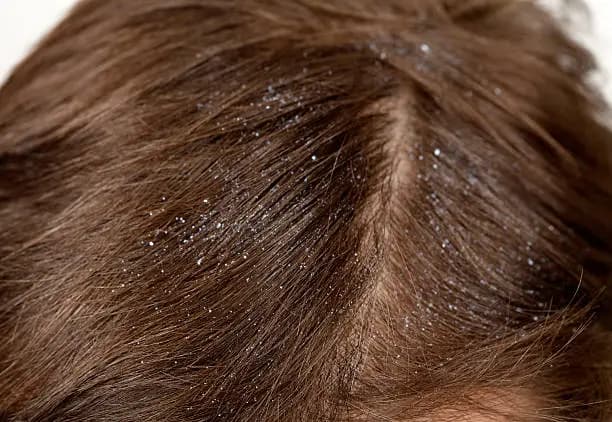 How to Avoid Dandruff in Hair Naturally