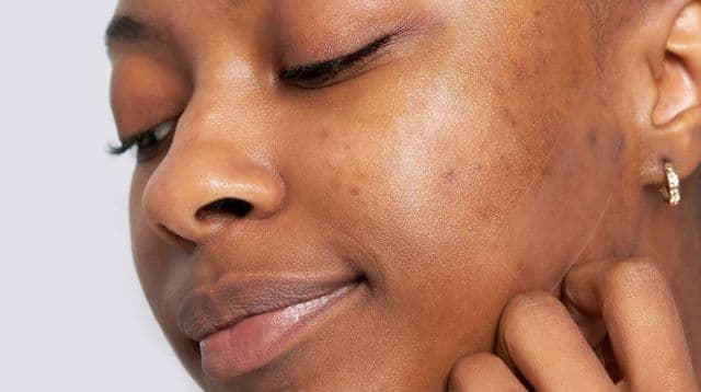 Natural Remedies For Hyperpigmentation In Melanin-Rich Skin