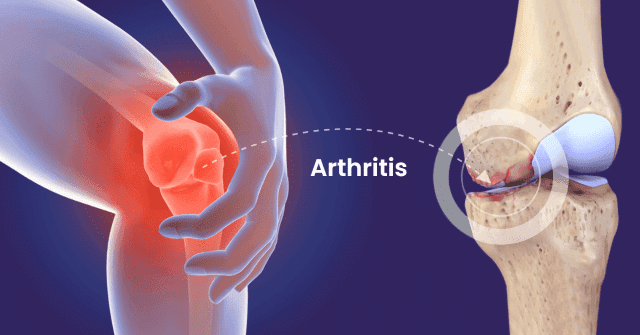 Health And Fitness: Arthritis And Ways Of Managing It