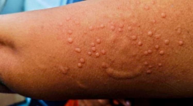 Mpox Outbreak Spreads to New Counties with 137 New Infections