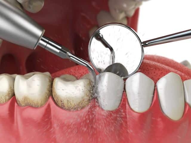 The Pros And Cons Of Deep Cleaning Teeth