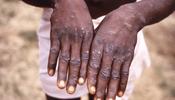 Ministry of Health confirms second case of Mpox in Kenya