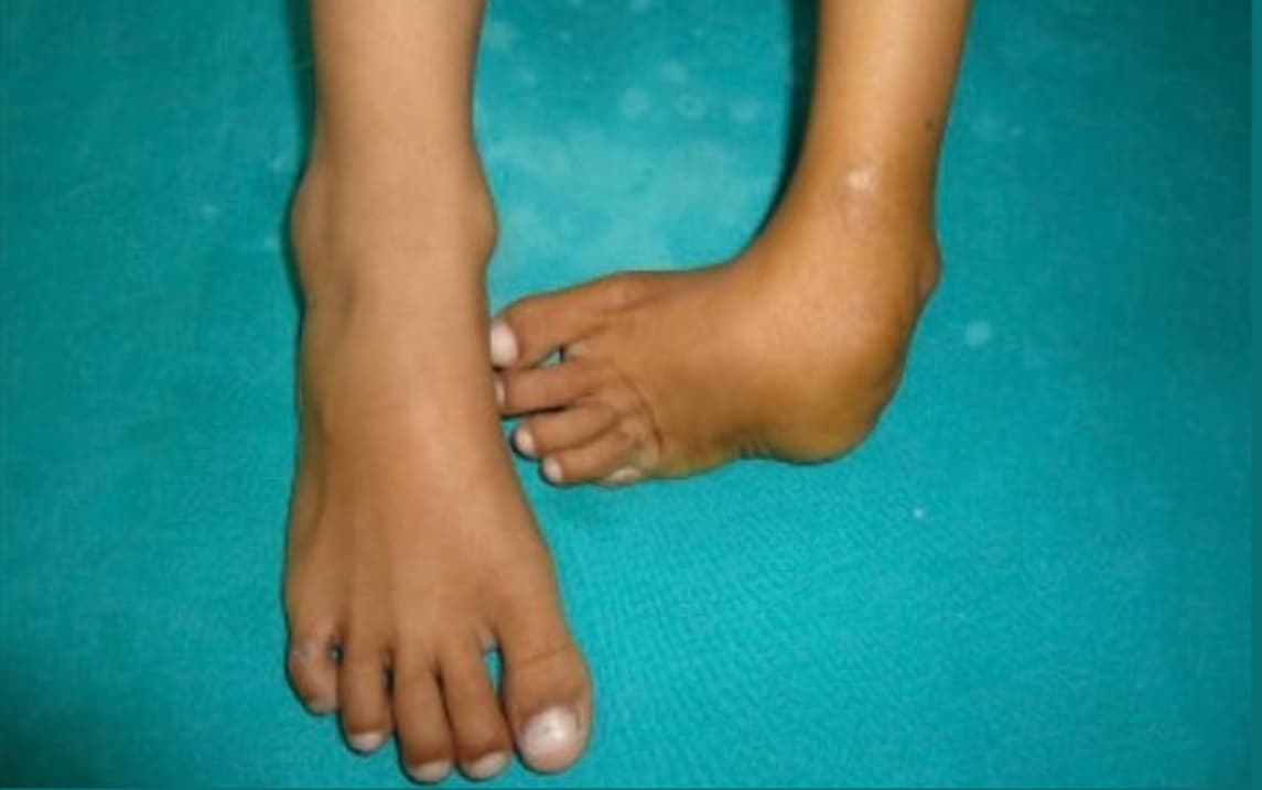 Everything you need to know about upper and lower limb reduction defects